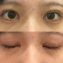 二重切開 / 目頭切開 / クマ治療 / 上まぶたの脂肪取り / 下まぶたの脂肪取り / タレ目形成・グラマラスライン（切開） BRIGHTS beauty clinic DAY 24 サムネイル用