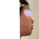 鼻尖形成（切開） Olino美容外科・美容皮膚科 DAY 50 サムネイル用