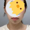 ボトックス（あご） / ヒアルロン酸注入（あご） フローラクリニック DAY 0 サムネイル用
