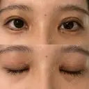 二重切開 / 目頭切開 / クマ治療 / 上まぶたの脂肪取り / 下まぶたの脂肪取り / タレ目形成・グラマラスライン（切開） BRIGHTS beauty clinic DAY 25 サムネイル用