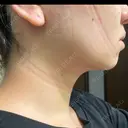 脂肪吸引（顔） / ボトックス（エラ・小顔） ルラ美容クリニック 大阪本院 DAY 2 サムネイル用