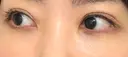 二重切開 / 眼瞼下垂（切開） / 目元修正 トップフェイス整形外科 DAY 129 サムネイル用