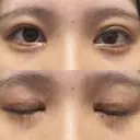 二重切開 / 目頭切開 / クマ治療 / 上まぶたの脂肪取り / 下まぶたの脂肪取り / タレ目形成・グラマラスライン（切開） BRIGHTS beauty clinic DAY 28 サムネイル用