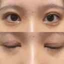 二重切開 / 目頭切開 / クマ治療 / 上まぶたの脂肪取り / 下まぶたの脂肪取り / タレ目形成・グラマラスライン（切開） BRIGHTS beauty clinic DAY 29 サムネイル用