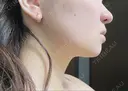 脂肪吸引（顔） / ボトックス（エラ・小顔） ルラ美容クリニック 大阪本院 DAY 5 サムネイル用