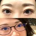 二重切開 / 上まぶたたるみ取り / PRP皮膚再生療法 BRIGHTS beauty clinic DAY 43 サムネイル用