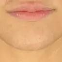 ヒアルロン酸注入（唇） / ボトックス（口角） / ボトックス（目尻） / その他（目元） TCB東京中央美容外科 高崎院 DAY 4 サムネイル用