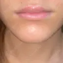 ヒアルロン酸注入（唇） / ボトックス（口角） / ボトックス（目尻） / その他（目元） TCB東京中央美容外科 高崎院 DAY 0 サムネイル用