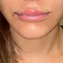 ヒアルロン酸注入（唇） / ボトックス（口角） / ボトックス（目尻） / その他（目元） TCB東京中央美容外科 高崎院 DAY 0 サムネイル用