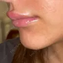 ヒアルロン酸注入（唇） / ボトックス（口角） / ボトックス（目尻） / その他（目元） TCB東京中央美容外科 高崎院 DAY 0 サムネイル用