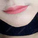 ヒアルロン酸注入（唇） / ボトックス（口角） / ボトックス（目尻） / その他（目元） TCB東京中央美容外科 高崎院 DAY 2 サムネイル用