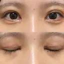 二重切開 / 目頭切開 / クマ治療 / 上まぶたの脂肪取り / 下まぶたの脂肪取り / タレ目形成・グラマラスライン（切開） BRIGHTS beauty clinic DAY 31 サムネイル用