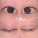 二重切開 / 上まぶたの脂肪取り 湘南美容クリニック 宇都宮院 AFTER サムネイル用