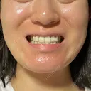 小鼻縮小（非切開） / ボトックス（エラ・小顔） 東京シンデレラ美容外科 池袋院 DAY 0 サムネイル用