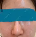 ピーリング（ハリ・ツヤ） まゆりなclinic 名古屋栄 DAY 4 サムネイル用