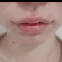 ヒアルロン酸注入（唇） 宇都宮ひふ科形成外科 DAY 0 サムネイル用