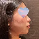 鼻尖形成（切開） Olino美容外科・美容皮膚科 DAY 60 サムネイル用