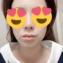 ハイフ（顔） 新宿中央クリニック DAY 2 サムネイル用