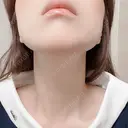 ハイフ（顔） 新宿中央クリニック DAY 2 サムネイル用