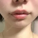 ヒアルロン酸注入（唇） 宇都宮ひふ科形成外科 DAY 1 サムネイル用
