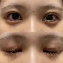 二重切開 / 目頭切開 / クマ治療 / 上まぶたの脂肪取り / 下まぶたの脂肪取り / タレ目形成・グラマラスライン（切開） BRIGHTS beauty clinic DAY 35 サムネイル用