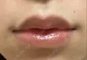 口唇縮小術 B-LINE CLINIC 池袋院 AFTER サムネイル用