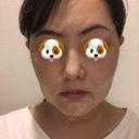 ハイフ（顔） オーキッド美容クリニック東京御徒町 DAY 0 サムネイル用
