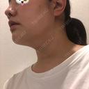 ハイフ（顔） オーキッド美容クリニック東京御徒町 DAY 0 サムネイル用