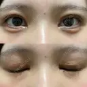 二重切開 / 目頭切開 / クマ治療 / 上まぶたの脂肪取り / 下まぶたの脂肪取り / タレ目形成・グラマラスライン（切開） BRIGHTS beauty clinic DAY 36 サムネイル用