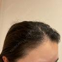 アートメイク（ヘアライン） トイトイトイクリニック 池袋院 DAY 7 サムネイル用