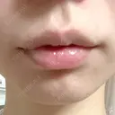 ヒアルロン酸注入（唇） 宇都宮ひふ科形成外科 DAY 3 サムネイル用
