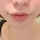 ヒアルロン酸注入（唇） 宇都宮ひふ科形成外科 AFTER サムネイル用