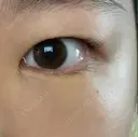 クマ治療 / 下まぶたの脂肪取り 湘南美容クリニック 長野院 DAY 8 サムネイル用