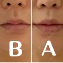 人中短縮 / 口角挙上 / ボトックス（口角） / ボトックス（人中） / その他（口元） eクリニック 金沢本院 DAY 106 サムネイル用