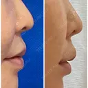 人中短縮 / 口角挙上 / ボトックス（口角） / ボトックス（人中） / その他（口元） eクリニック 金沢本院 DAY 106 サムネイル用