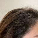 アートメイク（ヘアライン） トイトイトイクリニック 池袋院 DAY 9 サムネイル用