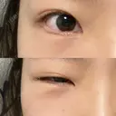 クマ治療 / 下まぶたの脂肪取り 湘南美容クリニック 長野院 DAY 10 サムネイル用