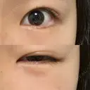 クマ治療 / 下まぶたの脂肪取り 湘南美容クリニック 長野院 DAY 10 サムネイル用