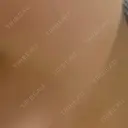 ほくろ・いぼ切除（肌） 大山皮膚科 AFTER サムネイル用