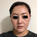 ハイフ（顔） オーキッド美容クリニック東京御徒町 DAY 8 サムネイル用