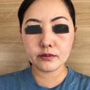 ハイフ（顔） オーキッド美容クリニック東京御徒町 DAY 12 サムネイル用