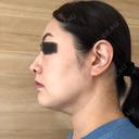 ハイフ（顔） オーキッド美容クリニック東京御徒町 DAY 12 サムネイル用