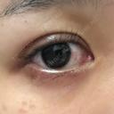 二重埋没 NARU Beauty Clinic 【ナルクリ】 DAY 3 サムネイル用