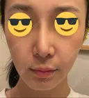 鼻尖縮小 / 鼻尖形成（非切開） / ヒアルロン酸注入（鼻） 東京ヒルズクリニック 銀座院 DAY 19 サムネイル用
