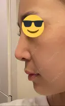 鼻尖縮小 / 鼻尖形成（非切開） / ヒアルロン酸注入（鼻） 東京ヒルズクリニック 銀座院 DAY 19 サムネイル用