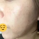 美肌レーザー / シミ取りレーザー あいちビューティークリニック DAY 0 サムネイル用