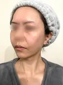 脂肪吸引（顔） / 切開リフト / 脂肪注入（輪郭） 牧野美容クリニック DAY 654 サムネイル用