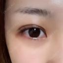 二重埋没 NARU Beauty Clinic 【ナルクリ】 DAY 5 サムネイル用