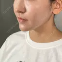 その他（目元） / 糸リフト / ボトックス（エラ・小顔） / 脂肪溶解注射（顔） / ボトックス（目尻） アリエル美容クリニック 大宮院 DAY 46 サムネイル用