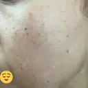 美肌レーザー / シミ取りレーザー あいちビューティークリニック DAY 1 サムネイル用